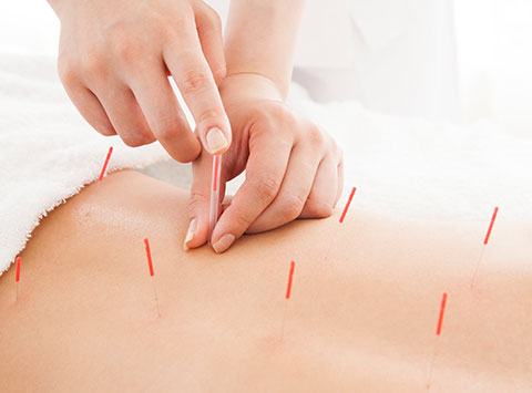 鍼灸治療