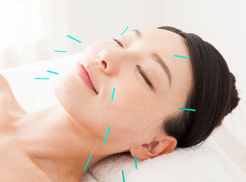美容鍼