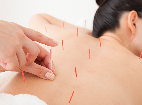 鍼灸治療をされる女性の背中